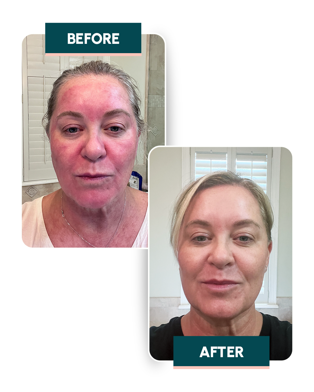Real customer before and after — calmer, clearer skin