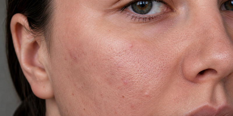 Before — uneven texture, visible pores and redness